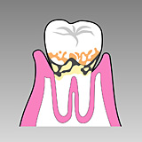 中等度の歯槽膿漏