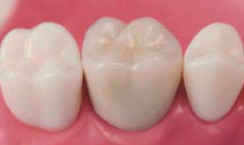 クラウン 被せ物 の種類 上前津歯科医院