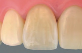 クラウン 被せ物 の種類 上前津歯科医院